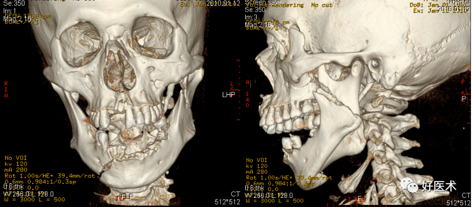 骨科医生必知的CT诊断，135张经典高清图详解！