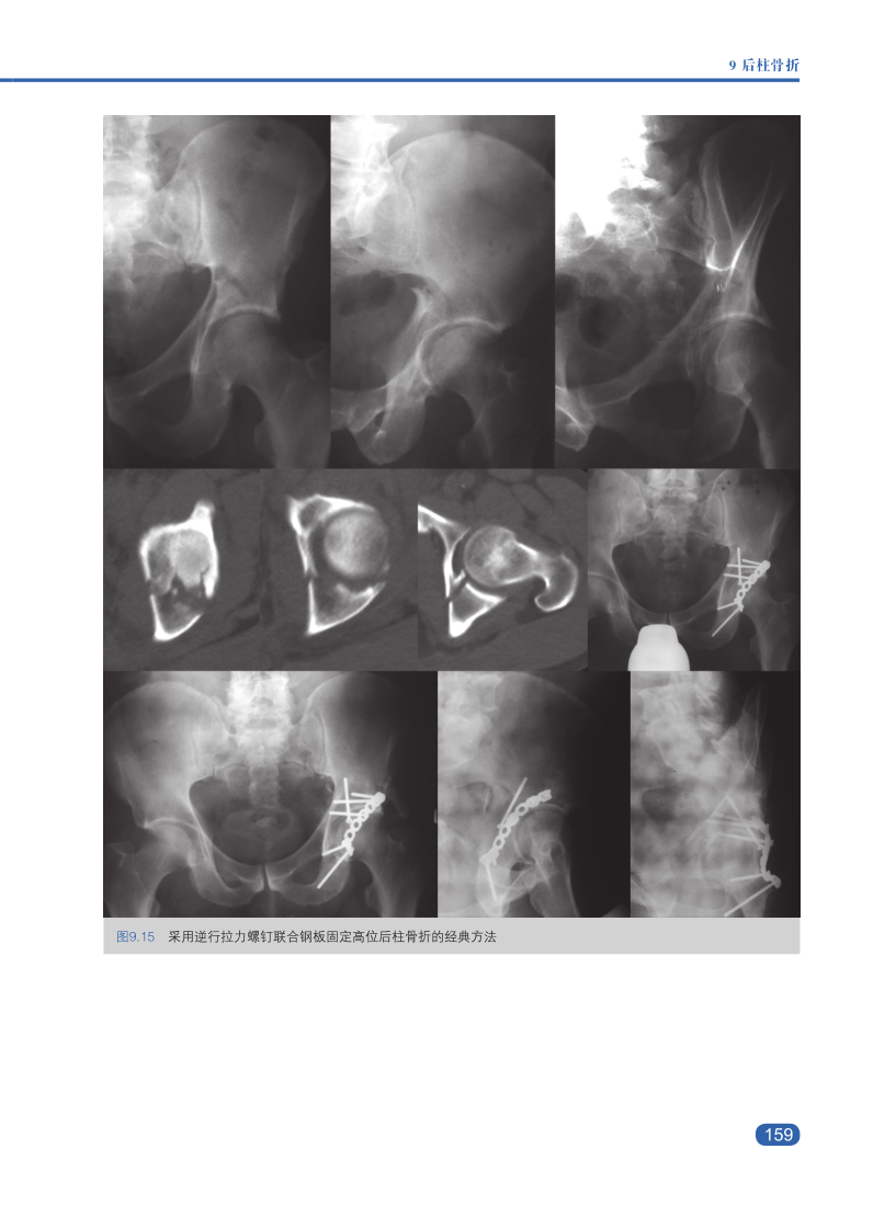 新书推髋臼骨折诊断、适应证与治疗策略，大咖思路都在这本书里！
