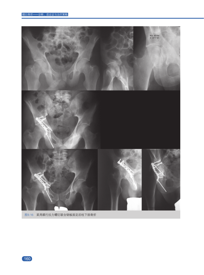新书推髋臼骨折诊断、适应证与治疗策略，大咖思路都在这本书里！