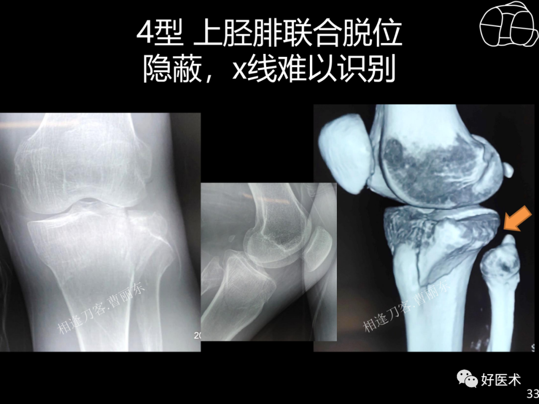 详解过伸型胫骨平台骨折新分型！ - 上海开为医药科技有限公司--创伤、肢体矫形技术解决方案的专业服务商