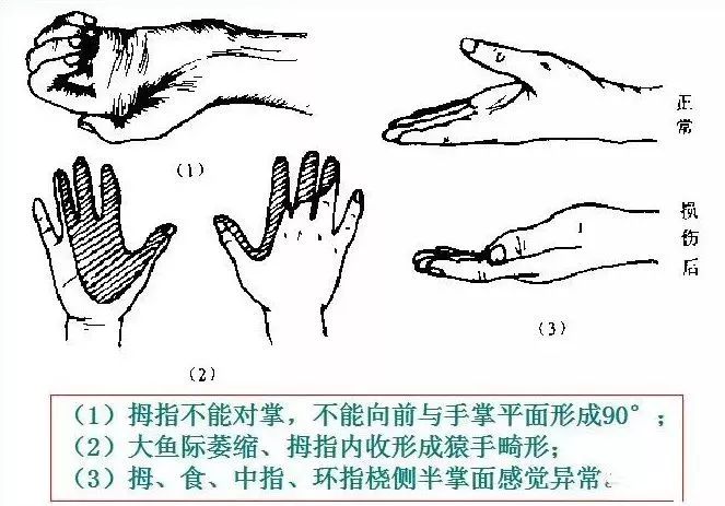 运动损伤检查及处理方法，此文非常实用！