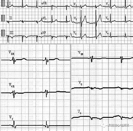 如何快速阅读心电图？记住这四步让你事半功倍！