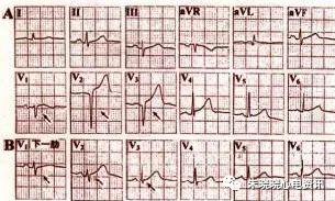 如何快速阅读心电图？记住这四步让你事半功倍！