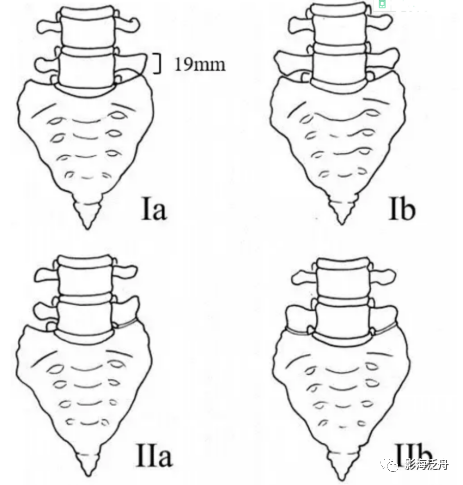 腰痛或下肢放射痛患者，请多关注L5横突！