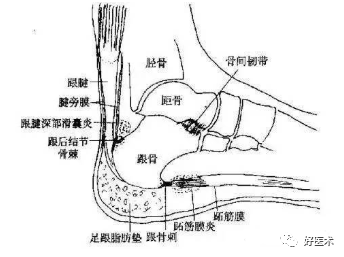 「足跟痛」并非都是骨刺惹的祸，14大“元凶”需警惕！