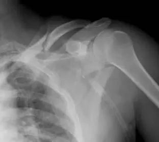 图文详解肩胛骨骨折解剖、分型、入路及内固定，必须收藏！