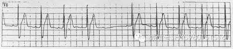 遇到这些严重的心律失常怎么办？诊治急救这么做！