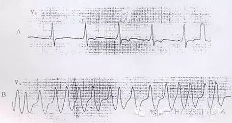 遇到这些严重的心律失常怎么办？诊治急救这么做！