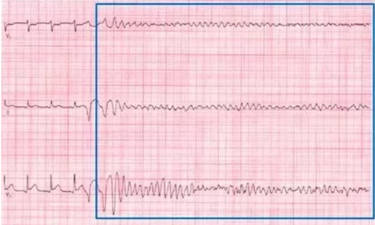 遇到这些严重的心律失常怎么办？诊治急救这么做！