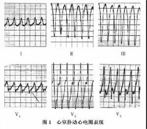 遇到这些严重的心律失常怎么办？诊治急救这么做！