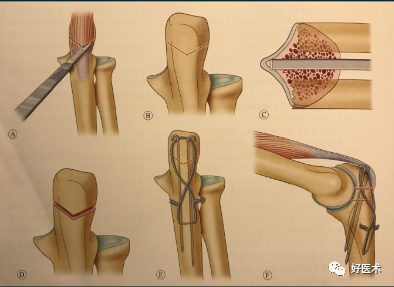 做好肱骨远端骨折手术，从熟悉解剖、分型及手术入路开始！