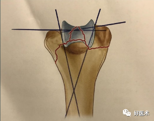 做好肱骨远端骨折手术，从熟悉解剖、分型及手术入路开始！