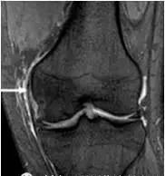 膝关节多种损伤MRI表现合集，记得收藏好！