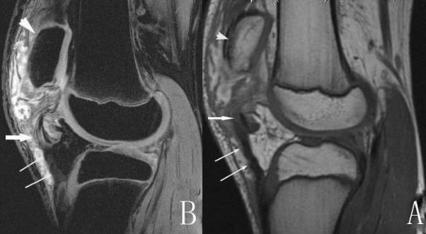膝关节多种损伤MRI表现合集，记得收藏好！