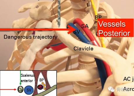 锁骨骨折解剖、切口及操作技巧，本文为你理清思路！