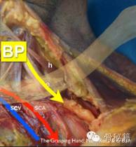 锁骨骨折解剖、切口及操作技巧，本文为你理清思路！