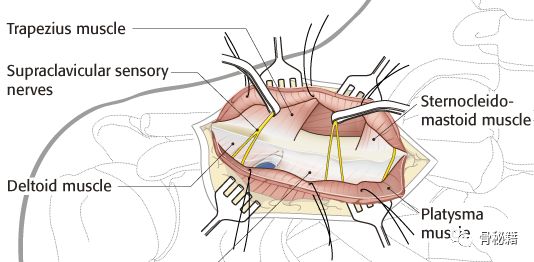锁骨骨折解剖、切口及操作技巧，本文为你理清思路！