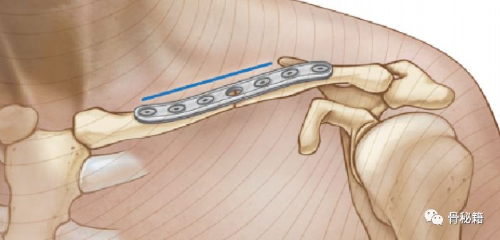 锁骨骨折解剖、切口及操作技巧，本文为你理清思路！