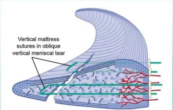 半月板损伤诊治关键技巧，够全够清晰！