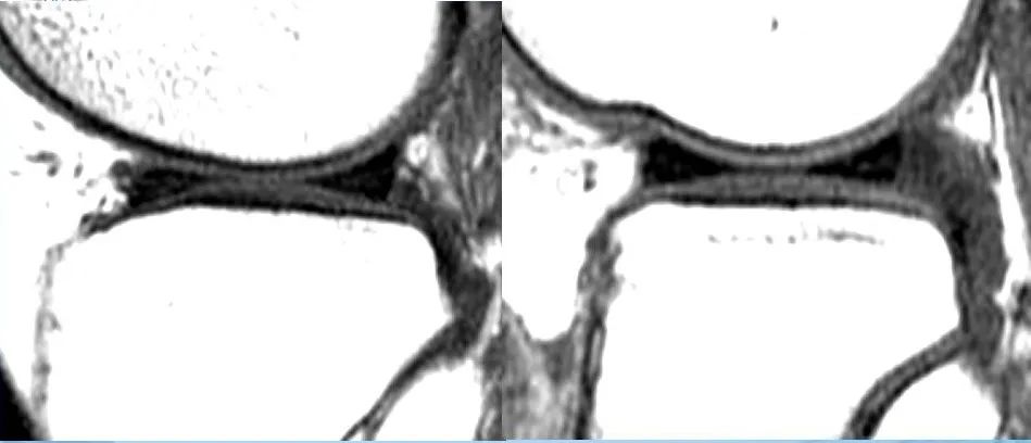 半月板损伤诊治关键技巧，够全够清晰！