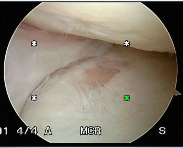 半月板损伤诊治关键技巧，够全够清晰！