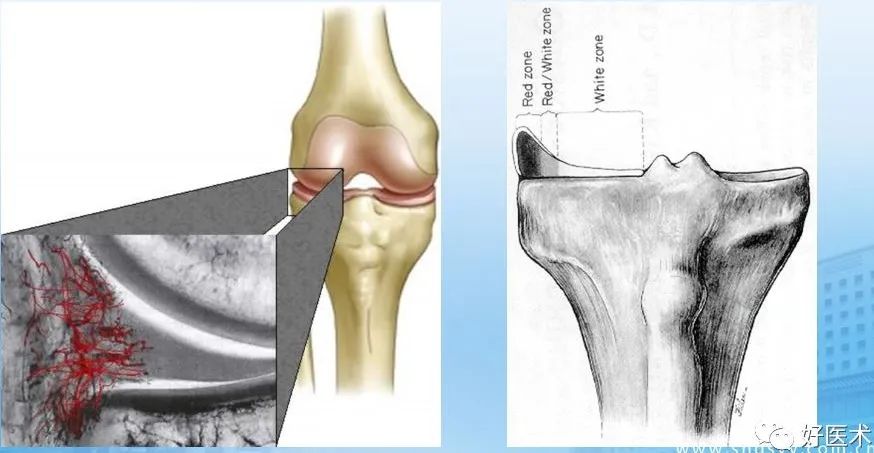 半月板损伤诊治关键技巧，够全够清晰！