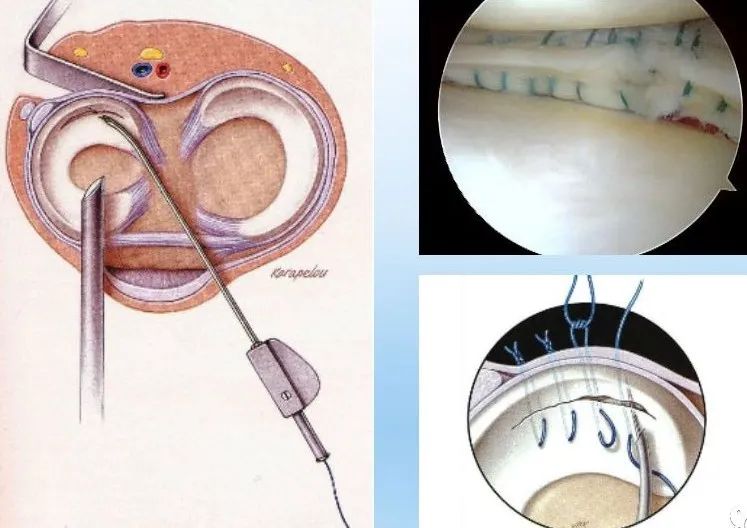 半月板损伤诊治关键技巧，够全够清晰！