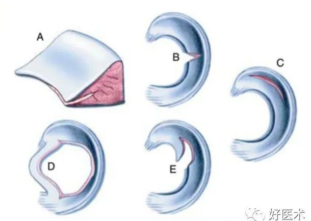 半月板损伤诊治关键技巧，够全够清晰！