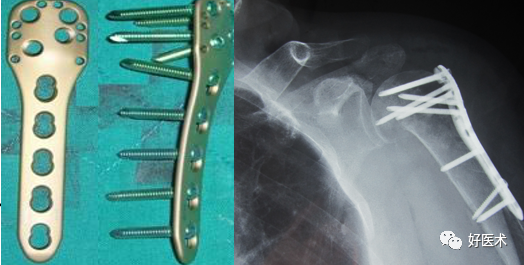 肱骨近端骨折：解剖、分型、治疗及内固定全面讲解！