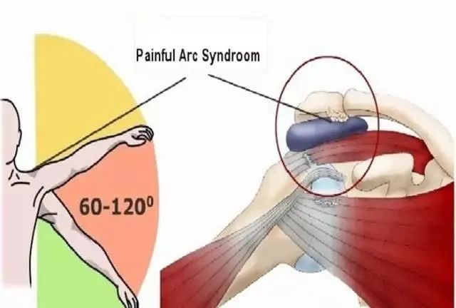 肩部疼痛就诊患者，65%都不是肩周炎惹的祸！