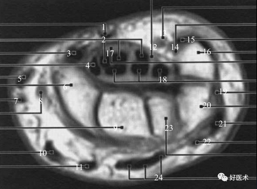 快速读懂腕关节MRI，不可错过的高清图注！