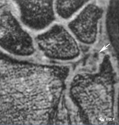 快速读懂腕关节MRI，不可错过的高清图注！