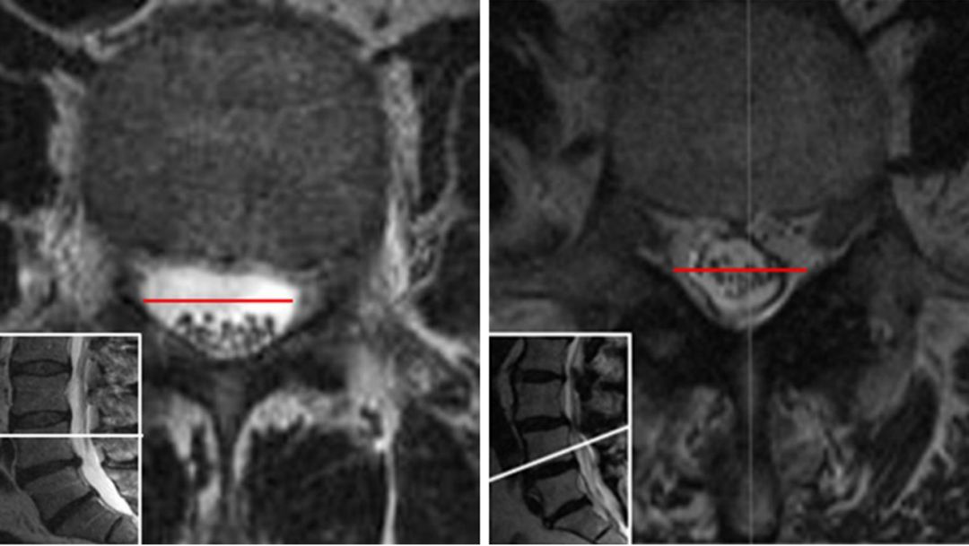 MRI提示腰椎管狭窄症的几个特殊征象，你肯定忽视过！