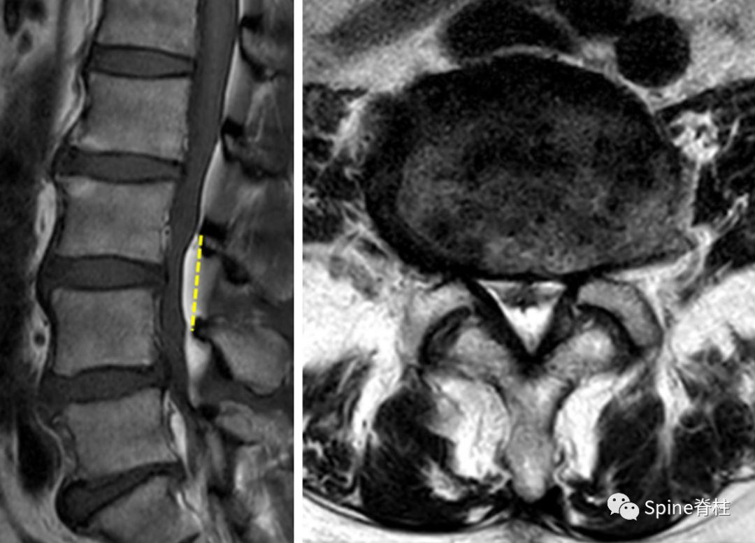 MRI提示腰椎管狭窄症的几个特殊征象，你肯定忽视过！
