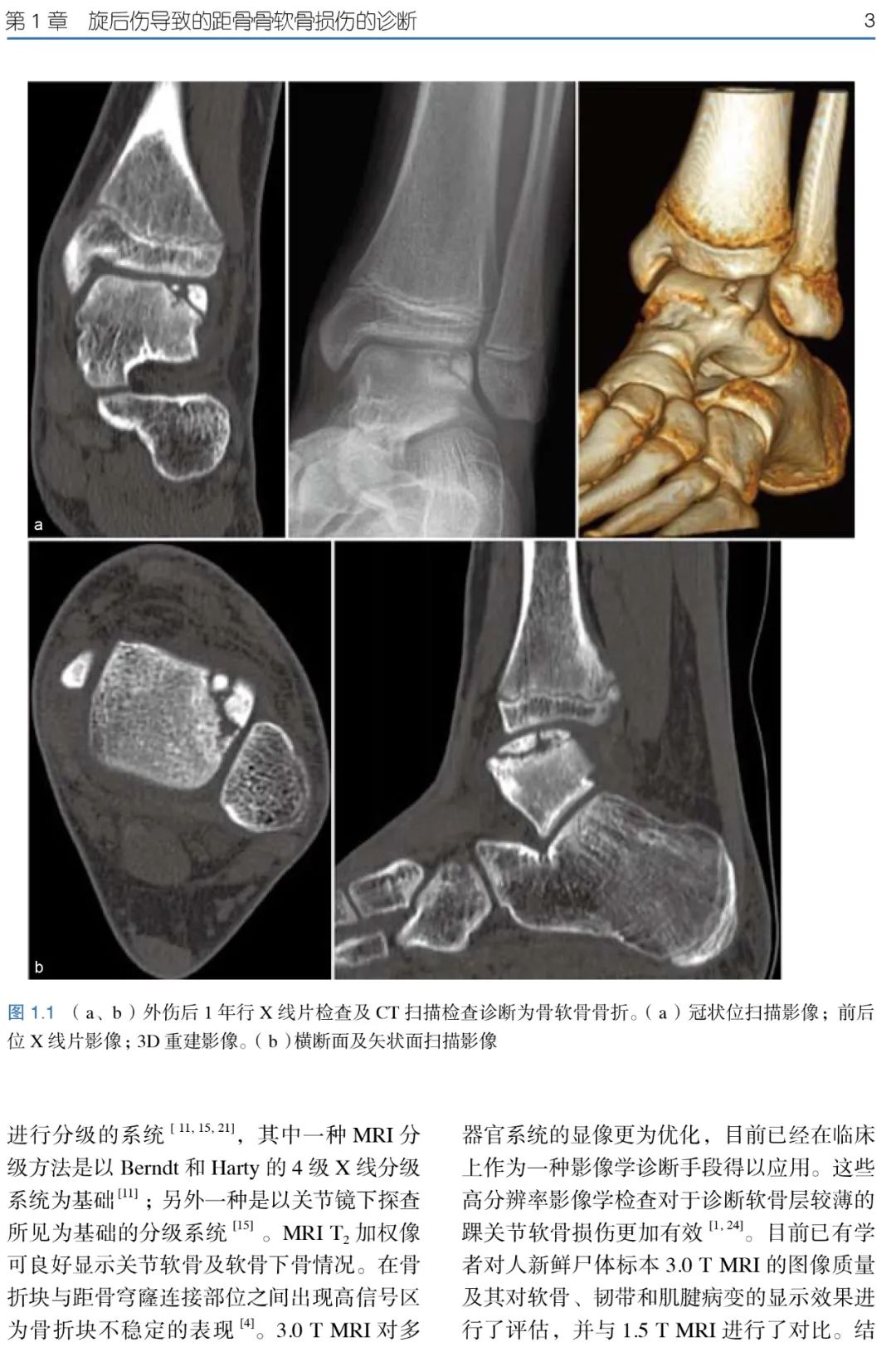 骨科医生诊治距骨骨软骨损伤的临床指南，欲购从速！