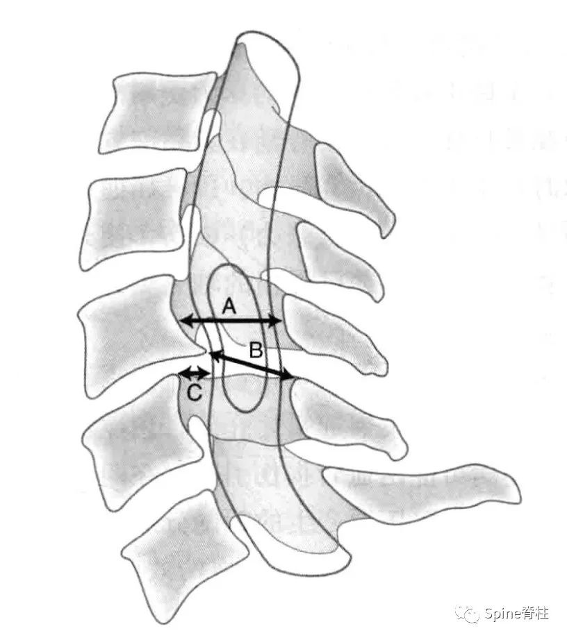 椎管狭窄矢状径图片