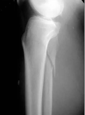 踝关节骨折诊治看似简单，但这个你肯定不知道！