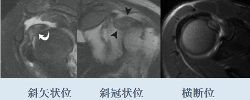 被忽略的肩痛：肱二头肌长头腱，你Get了吗？