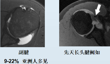 被忽略的肩痛：肱二头肌长头腱，你Get了吗？