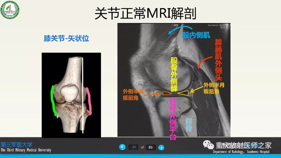 膝关节韧带解剖及MRI诊断，精确到每个细节！