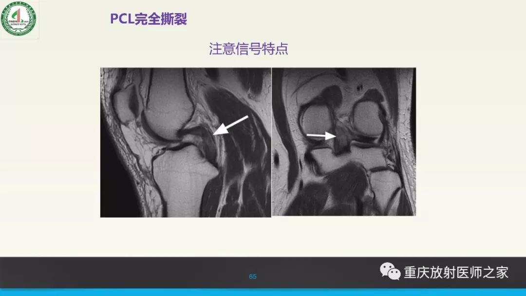 膝关节韧带解剖及MRI诊断，精确到每个细节！