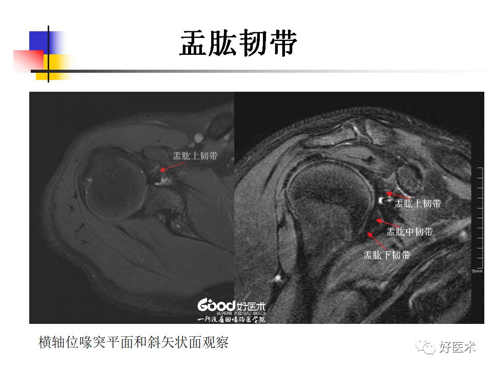超全超清晰：图解肩关节MRI解剖及损伤诊断要点！