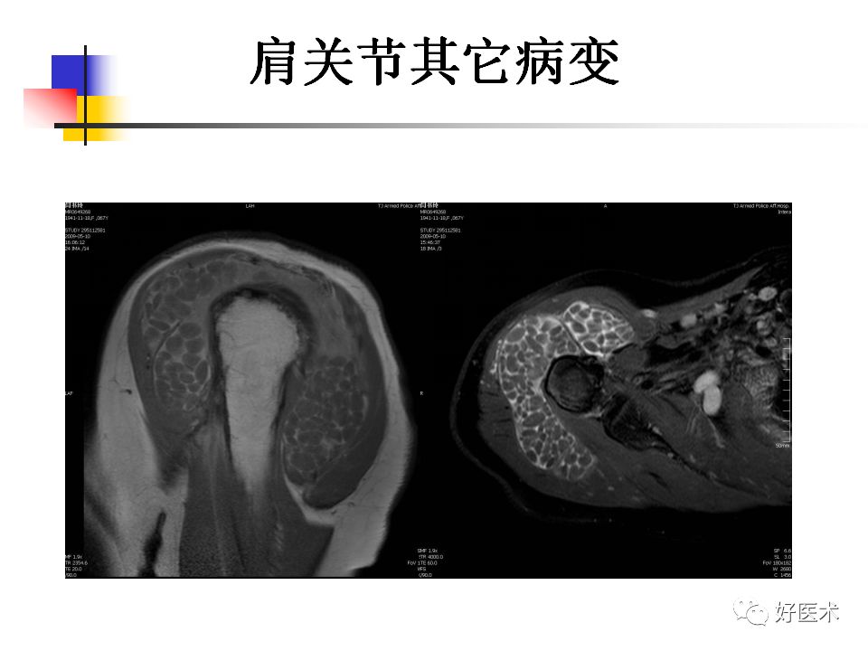 超全超清晰：图解肩关节MRI解剖及损伤诊断要点！