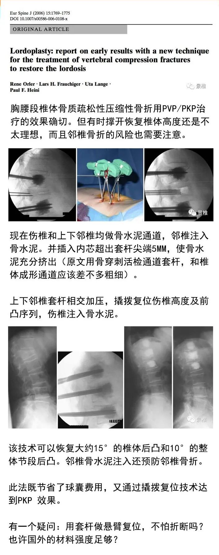 做好椎体成形术必看的8张卡片，果断收藏了！