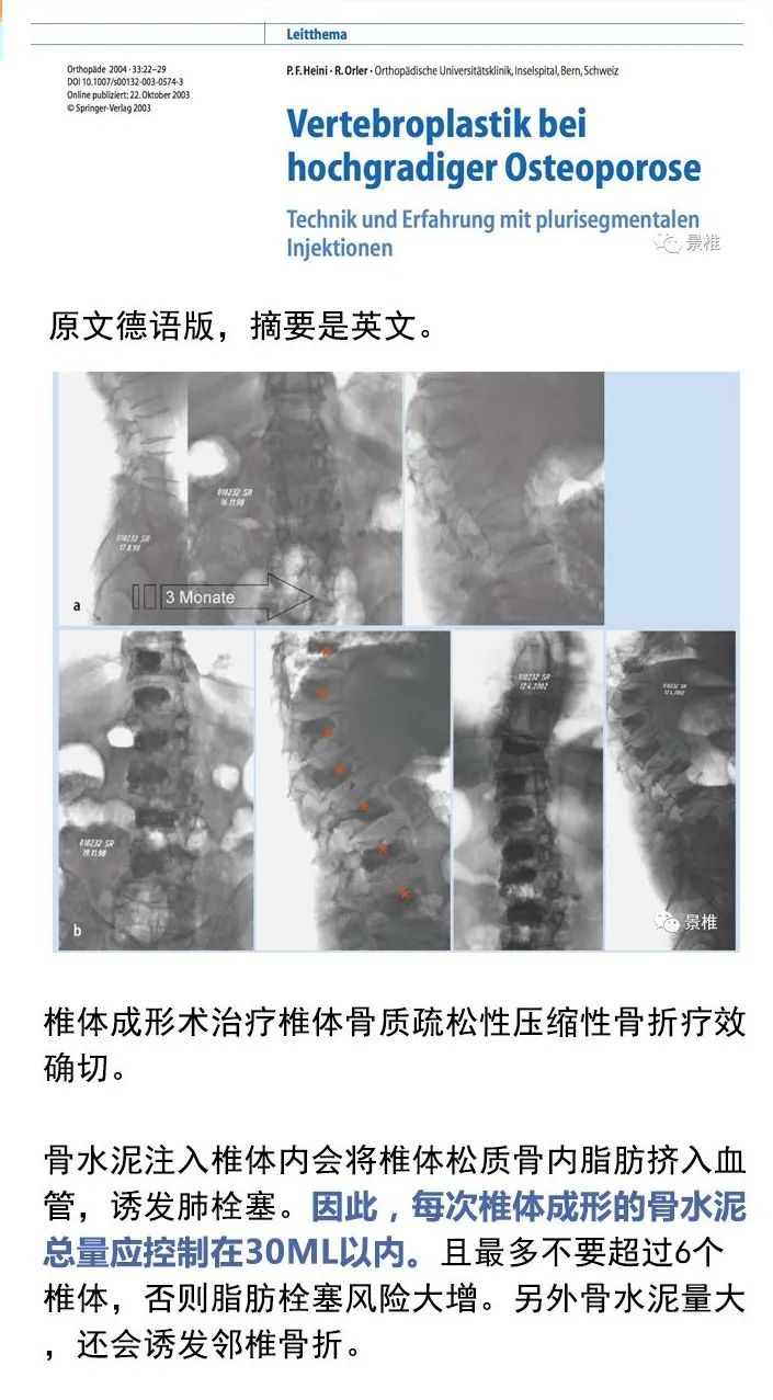 做好椎体成形术必看的8张卡片，果断收藏了！