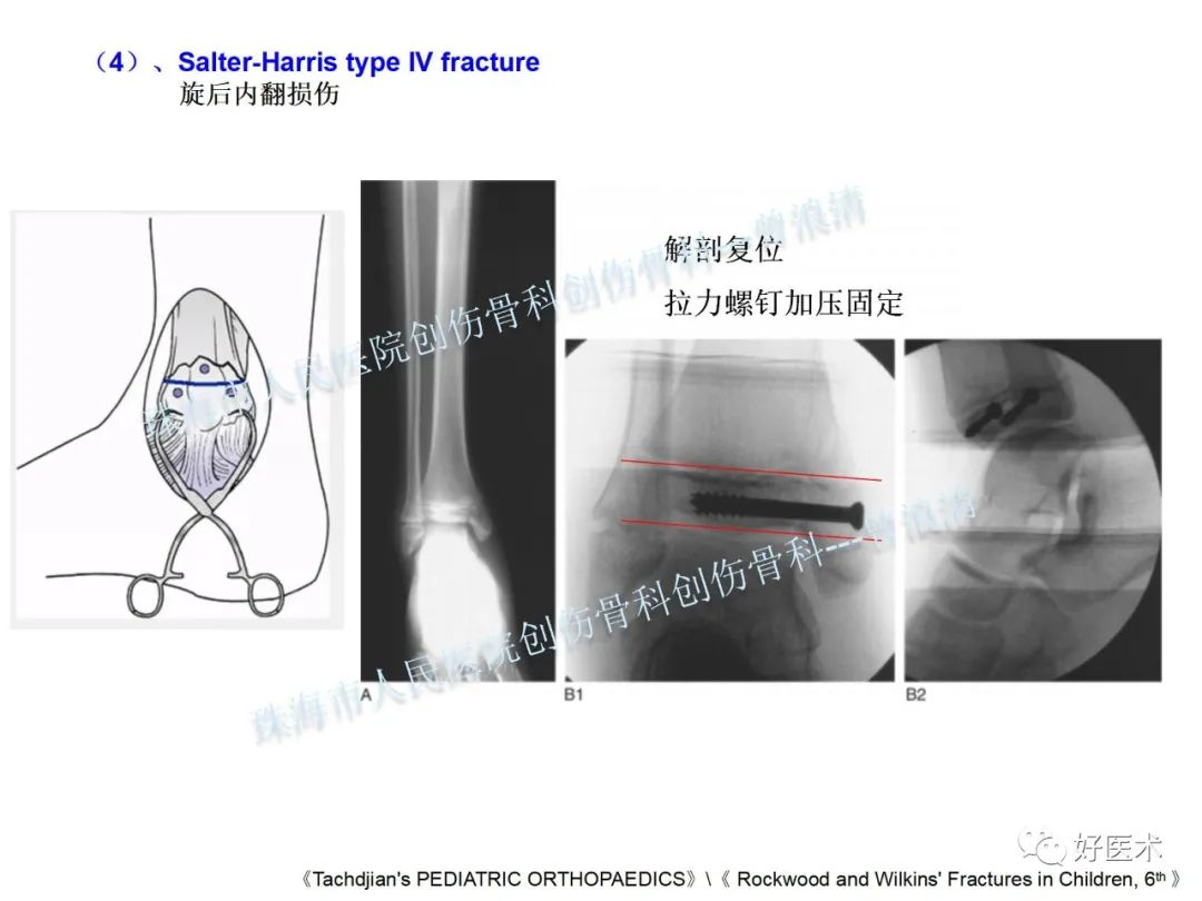 纯高清图谱讲解儿童踝关节骨折，99%的人都能看懂！