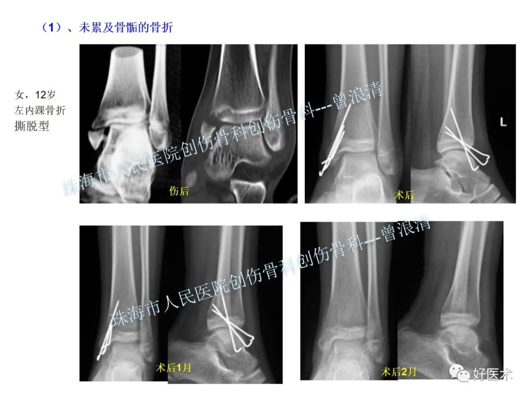 纯高清图谱讲解儿童踝关节骨折，99%的人都能看懂！