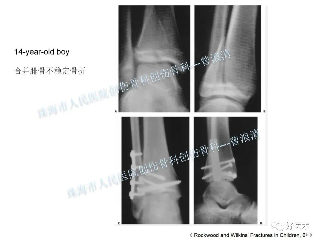纯高清图谱讲解儿童踝关节骨折，99%的人都能看懂！