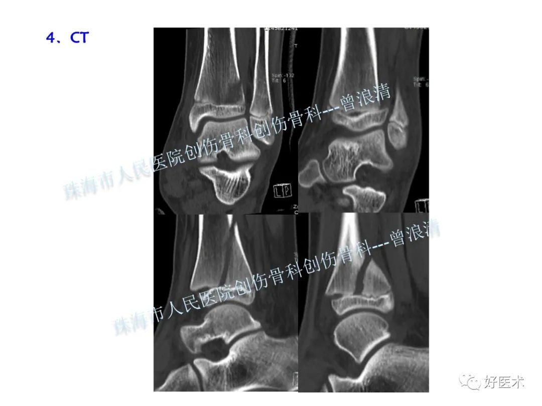 纯高清图谱讲解儿童踝关节骨折，99%的人都能看懂！