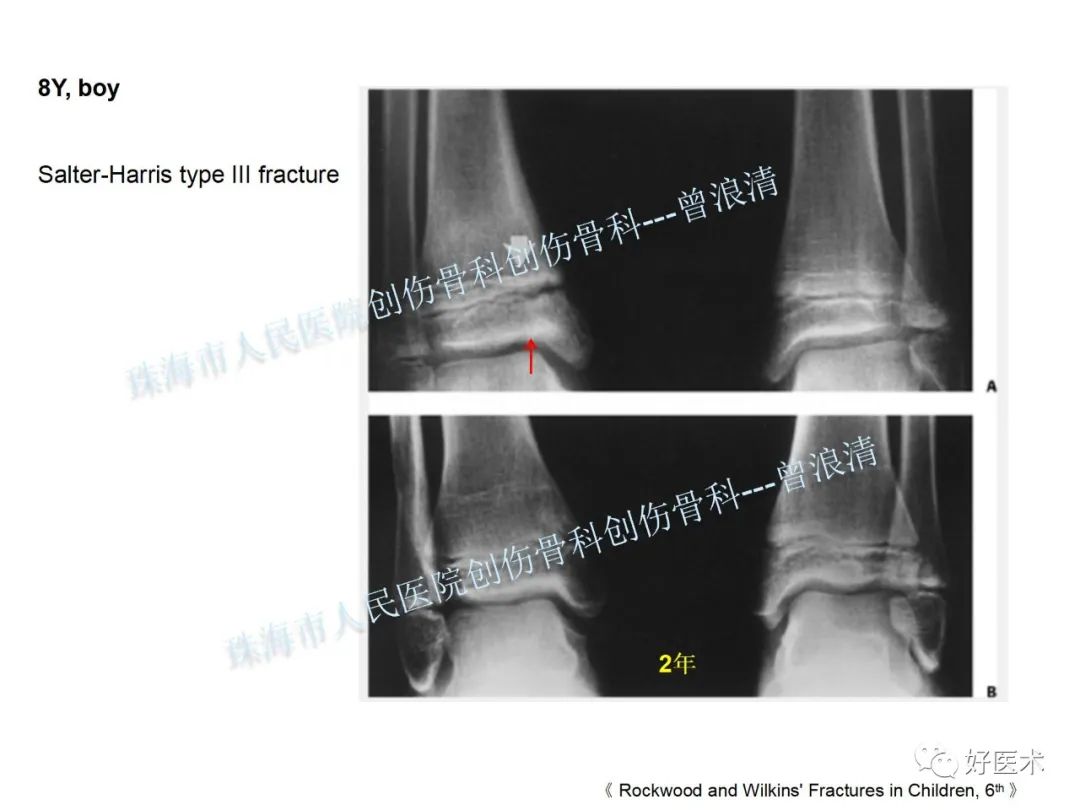 纯高清图谱讲解儿童踝关节骨折，99%的人都能看懂！